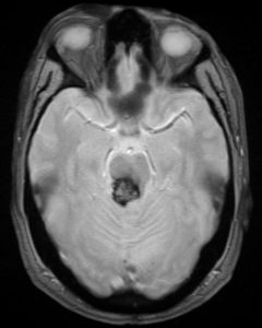 cavernoma cerebrale