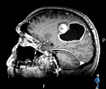 Glioblastoma