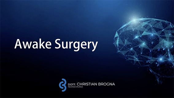 Che cos'è l'Awake Surgery?