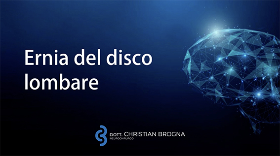 Ernia del disco lombare