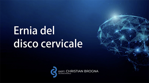 Ernia del disco cervicale